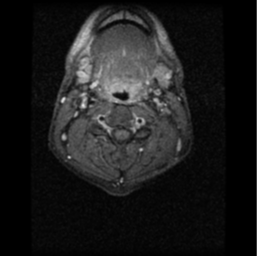 File:Cervical vertebrae metastasis (Radiopaedia 78814-91667 Axial T1 C+ fat sat 2).png