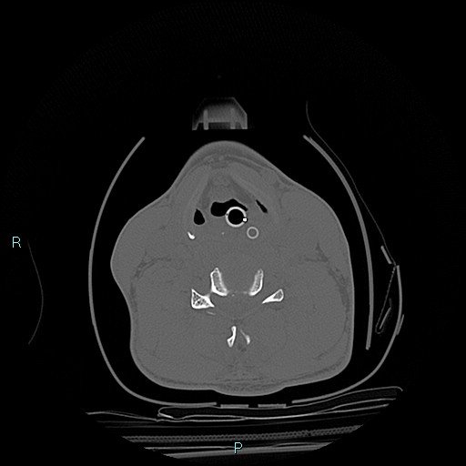 File:Cervical vertebral burst fracture (Radiopaedia 37420-39258 Axial bone window 15).jpg