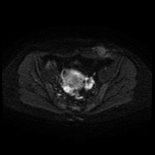 Cesarian section scar endometriosis (Radiopaedia 66520-75799 Axial DWI 34).jpg