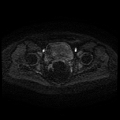 Cesarian section scar endometriosis (Radiopaedia 66520-75799 Axial DWI 67).jpg