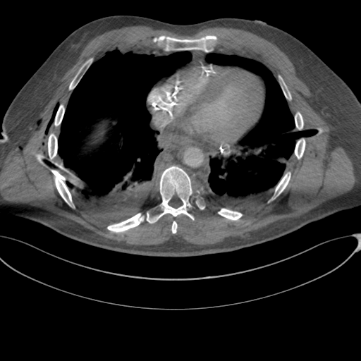 File:Chest multitrauma - aortic injury (Radiopaedia 34708-36147 A 197).png