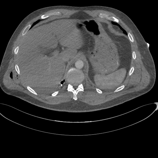 File:Chest multitrauma - aortic injury (Radiopaedia 34708-36147 A 275).png