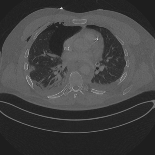 Chest multitrauma - aortic injury (Radiopaedia 34708-36147 Axial bone window 162).png