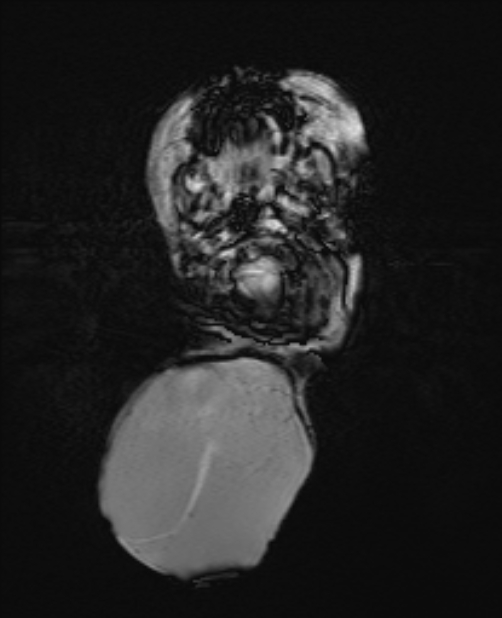 Chiari III malformation with occipital encephalocele (Radiopaedia 79446-92559 Axial SWI 20).jpg