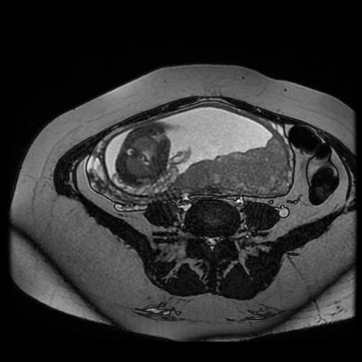 Chiari II malformation - fetal MRI (Radiopaedia 68099-77581 Axial Fiesta 25).jpg