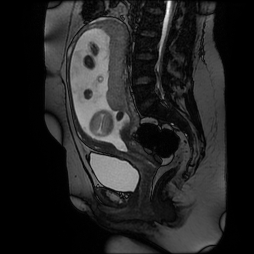Chiari II malformation - fetal MRI (Radiopaedia 68099-77581 Sagittal Fiesta 29).jpg
