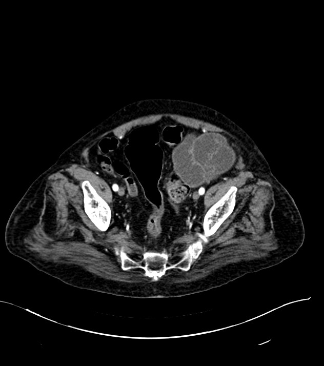 Cholangiocarcinoma with cerebral metastases (Radiopaedia 83519-98629 B 105).jpg