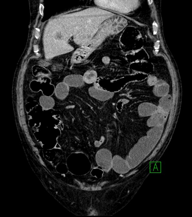 Cholangiocarcinoma with cerebral metastases (Radiopaedia 83519-98629 G 23).jpg