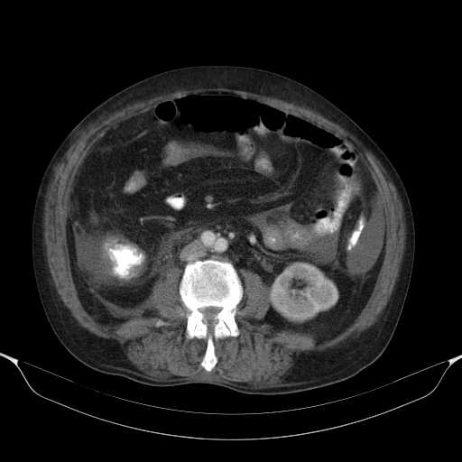 File:Cholangitis and abscess formation in a patient with cholangiocarcinoma (Radiopaedia 21194-21100 A 28).jpg
