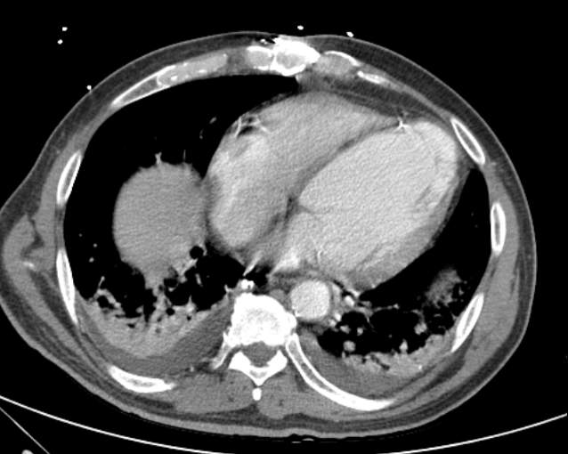 File:Cholecystitis - perforated gallbladder (Radiopaedia 57038-63916 A 8).jpg