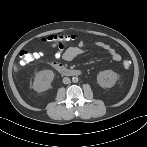 File:Cholecystitis with focal perforation and hepatic abscess (Radiopaedia 37189-38945 Axial non-contrast 42).png