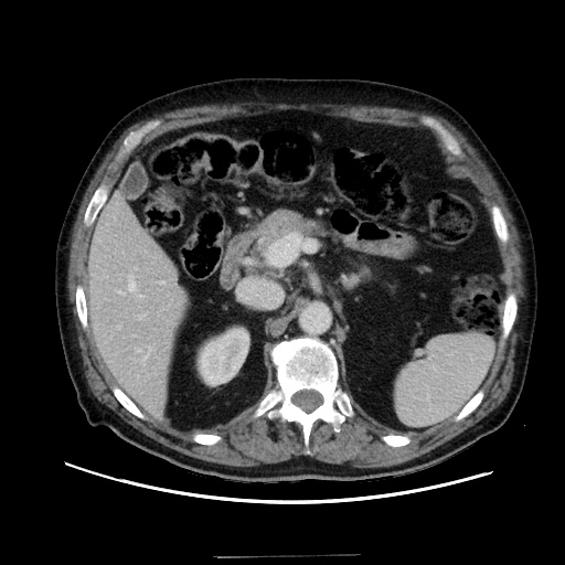 Choledocholiathiasis with normal caliber common bile duct (Radiopaedia 75368-86632 A 66).jpg