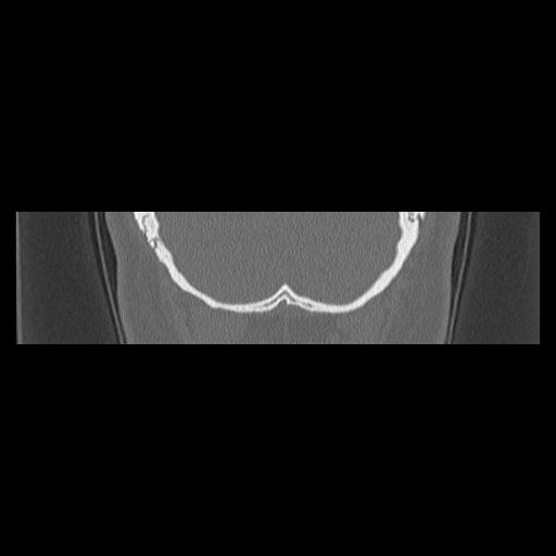 Cholesteatoma (Radiopaedia 84946-100455 Coronal bone window 148).jpg