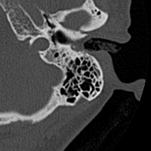 File:Cholesteatoma of the external ear (Radiopaedia 16540-16225 Axial bone window 26).jpg