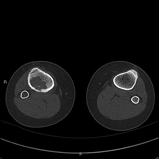 Chondroblastoma (Radiopaedia 62721-71030 Axial bone window 89).jpg