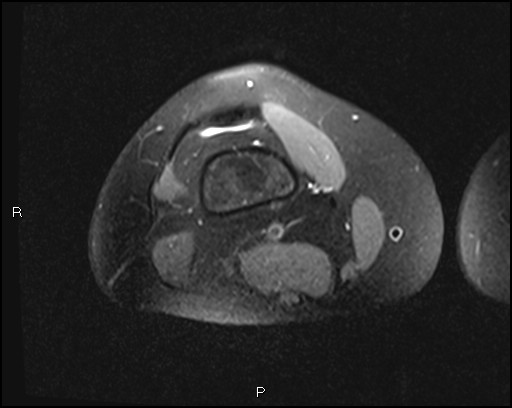 File:Chondroblastoma (Radiopaedia 62721-71031 Axial PD fat sat 6).jpg