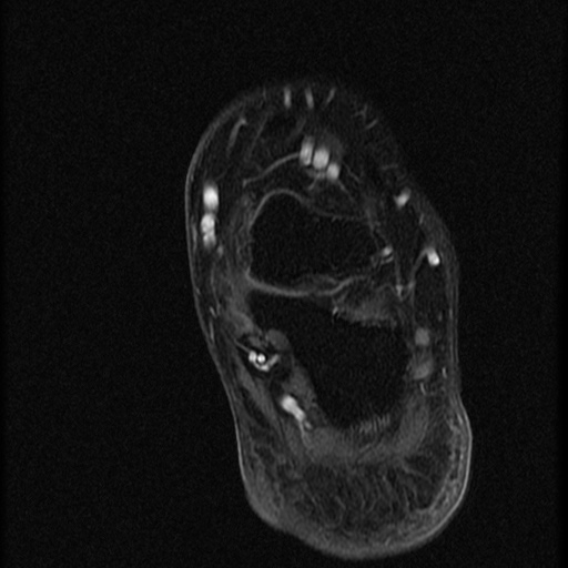 File:Chondroblastoma - midfoot (Radiopaedia 64831-73765 G 3).jpg