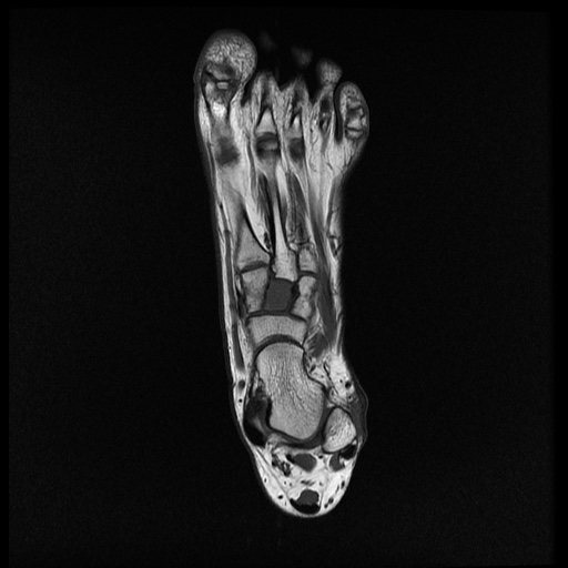 File:Chondroblastoma - midfoot (Radiopaedia 64831-73765 Long axis T1 15).jpg