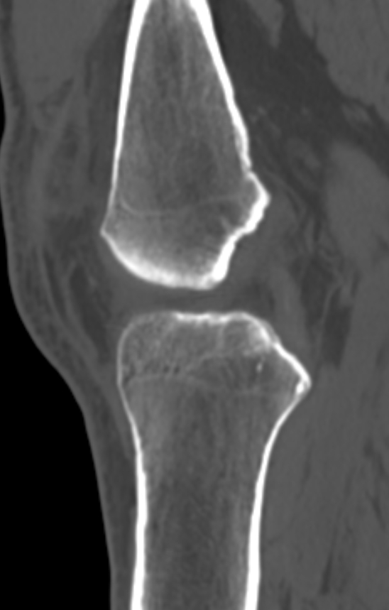 Chondrocalcinosis (Radiopaedia 82862-97173 Sagittal bone window 30).jpg