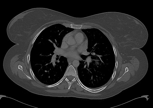 Chondrosarcoma - chest wall (Radiopaedia 65192-74199 Axial bone window 58).jpg