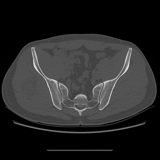 File:Chondrosarcoma of iliac wing (Radiopaedia 63861-72599 Axial bone window 66).jpg