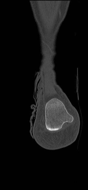 Chopart fracture (Radiopaedia 35347-36851 Coronal bone window 8).jpg