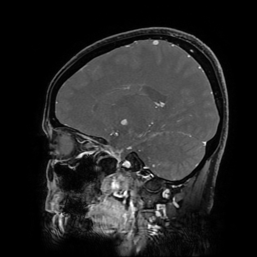 File:Chordoid glioma of third ventricle (Radiopaedia 91612-109340 F 130).jpg
