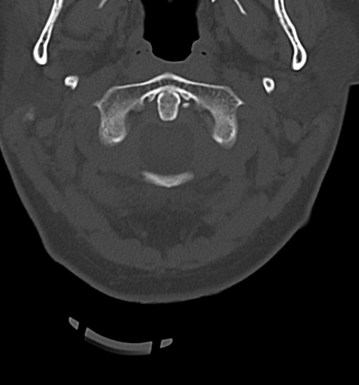 Chordoma (C4 vertebra) (Radiopaedia 47561-52188 Axial bone window 7).png