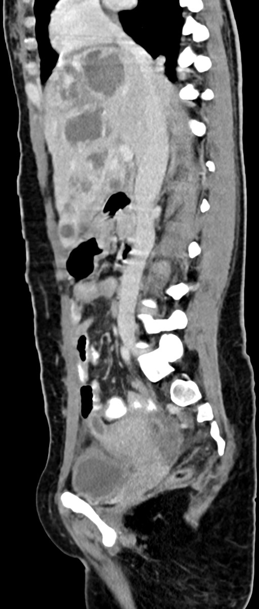 Choriocarcinoma liver metastases (Radiopaedia 74768-85766 C 109).jpg