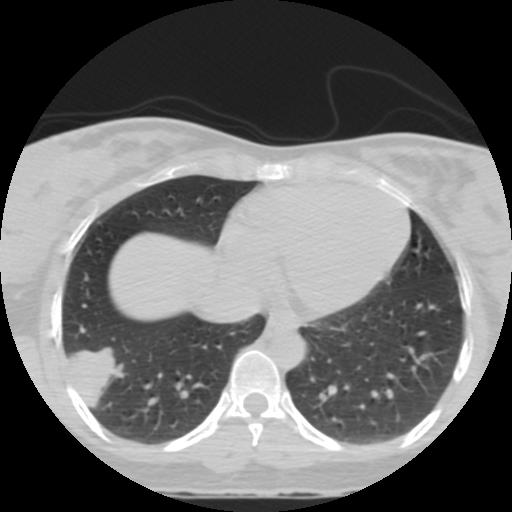 File:Choriocarcinoma of ovary with cerebral and pulmonary metastases (Radiopaedia 25983-26119 Axial lung window 17).jpg