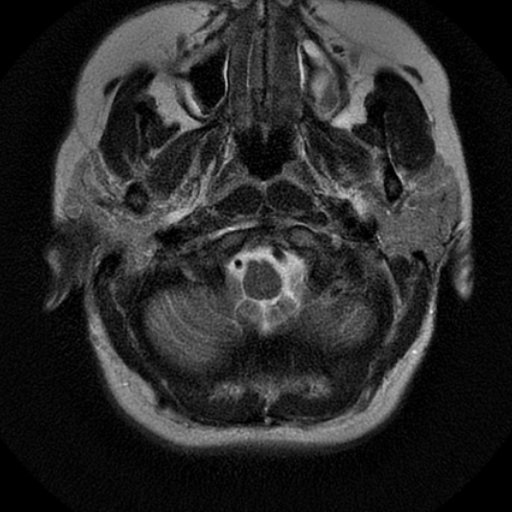 File:Choroid plexus xanthogranuloma (Radiopaedia 17650-17386 T2 23).jpg