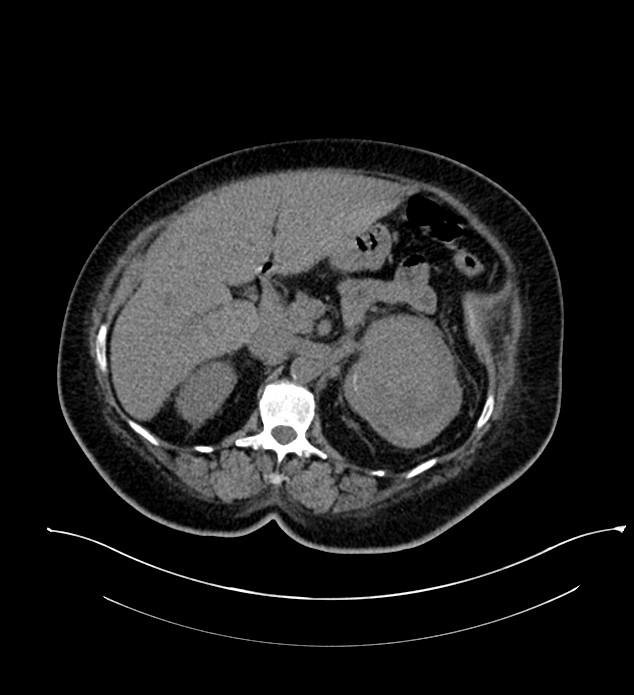 Chromophobe renal cell carcinoma (Radiopaedia 84239-99519 Axial non-contrast 63).jpg