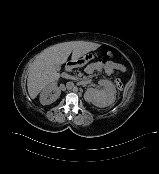 Chromophobe renal cell carcinoma (Radiopaedia 84239-99519 Axial non-contrast 71).jpg