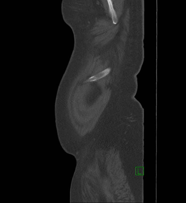 Chromophobe renal cell carcinoma (Radiopaedia 84239-99519 Sagittal bone window 103).jpg