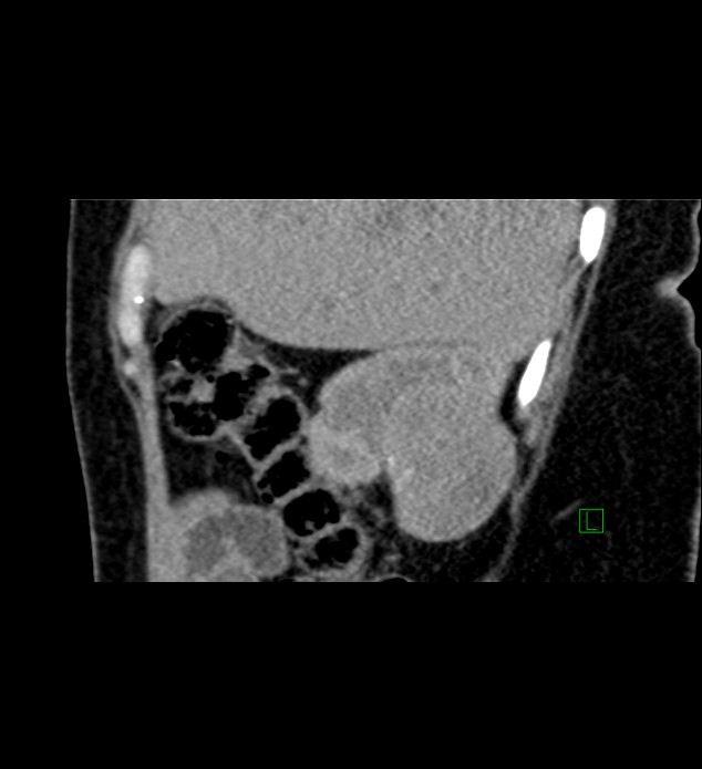 Chromophobe renal cell carcinoma (Radiopaedia 84290-99582 D 77).jpg