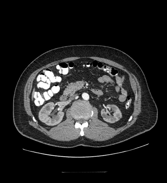 Chromophobe renal cell carcinoma (Radiopaedia 84337-99644 B 43).jpg