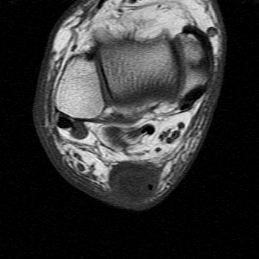 File:Chronic Achilles tendon rupture (Radiopaedia 15262-15100 Axial T1 13).jpg