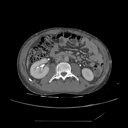 File:Chronic IVC thrombosis and resultant IVC filter malposition (Radiopaedia 81158-94800 A 103).jpg