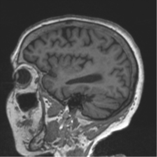 Chronic hypertensive encephalopathy (Radiopaedia 39993-42482 Sagittal T1 29).png