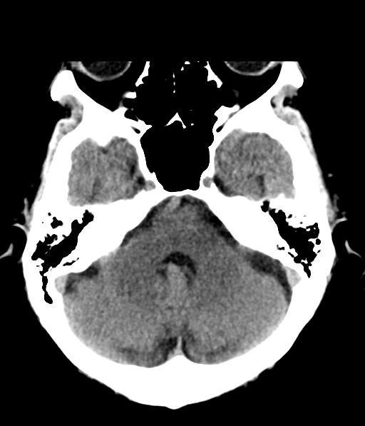 File:Chronic hypertensive encephalopathy (Radiopaedia 39993-42485 Axial non-contrast 10).png