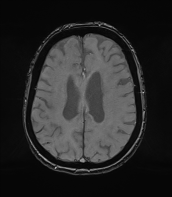 Chronic hypertensive encephalopathy (Radiopaedia 72844-83495 Axial SWI magnitude 58).png