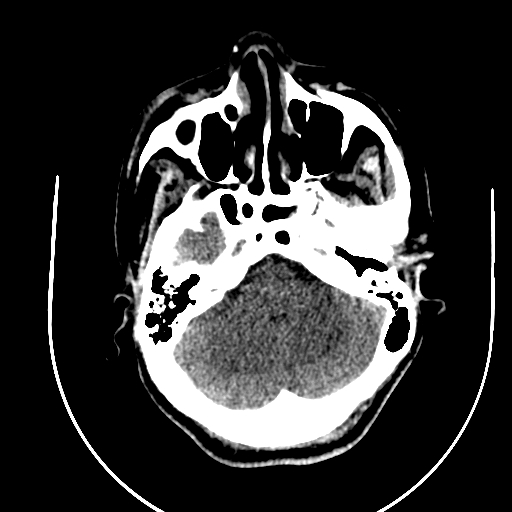 Chronic invasive fungal sinusitis (Radiopaedia 91563-109286 Axial non-contrast 17).jpg