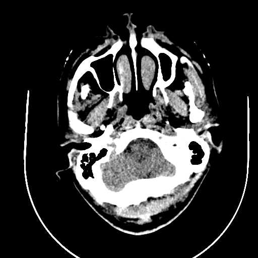 File:Chronic invasive fungal sinusitis (Radiopaedia 91563-109286 Axial non-contrast 2).jpg