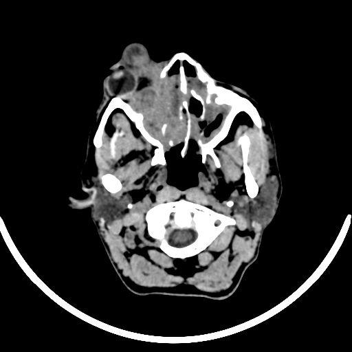 File:Chronic invasive fungal sinusitis with intraorbital and intracranial extension (Radiopaedia 56387-63046 Axial non-contrast 74).jpg