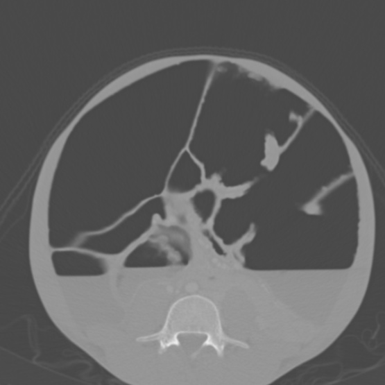 File:Chronic large bowel pseudo-obstruction (Radiopaedia 43181-46492 Axial bone window 109).jpg