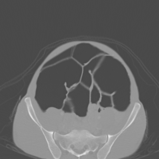 File:Chronic large bowel pseudo-obstruction (Radiopaedia 43181-46492 Axial bone window 131).jpg