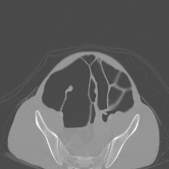 File:Chronic large bowel pseudo-obstruction (Radiopaedia 43181-46492 Axial bone window 138).jpg