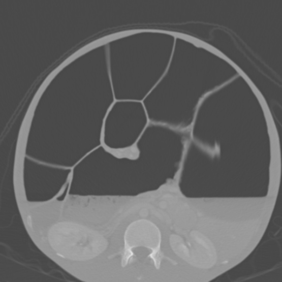 File:Chronic large bowel pseudo-obstruction (Radiopaedia 43181-46492 Axial bone window 86).jpg