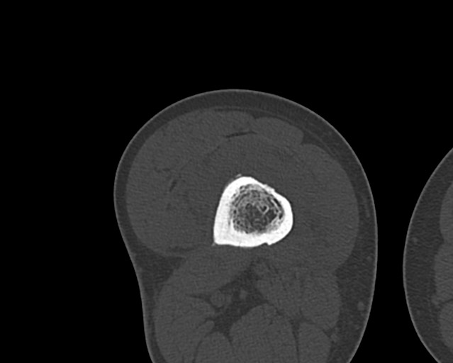 Chronic ostemyelitis of the femur with long sinus tract (Radiopaedia 74947-85982 Axial bone window 138).jpg