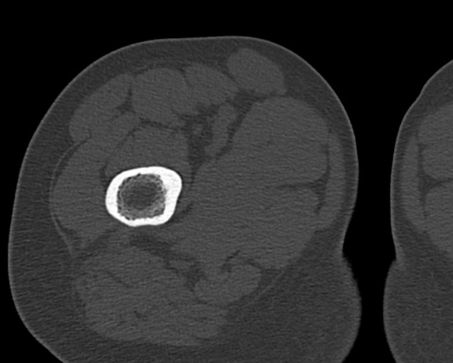 Chronic ostemyelitis of the femur with long sinus tract (Radiopaedia 74947-85982 Axial bone window 36).jpg